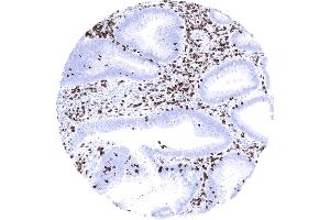 Colon Strong CD7 staining of a large fraction of tumor infiltrating lymphocytes in a colorectal adenocarcinoma. (Recombinant CD7 anticorps)