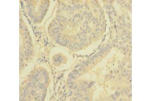Immunohistochemistry of paraffin-embedded human endometrial cancer using ABIN7160909 at dilution of 1:100 (NDUFA6 anticorps  (AA 27-154))