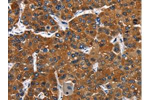 The image on the left is immunohistochemistry of paraffin-embedded Human liver cancer tissue using ABIN7128793(CATSPER3 Antibody) at dilution 1/60, on the right is treated with fusion protein. (CATSPER3 anticorps)