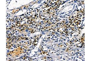 ABIN7094959 and ABIN7099015 at 1/100 staining human esophageal cancer by IHC-P. (PAXIP1 anticorps)