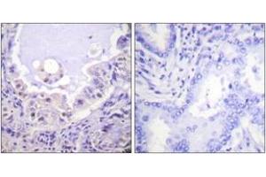 Immunohistochemistry analysis of paraffin-embedded human lung carcinoma tissue, using C-RAF (Ab-621) Antibody. (RAF1 anticorps  (AA 591-640))