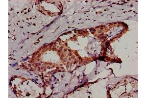 IHC image of ABIN7156261 diluted at 1:500 and staining in paraffin-embedded human breast cancer performed on a Leica BondTM system.