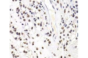 Immunohistochemistry of paraffin-embedded Human kidney cancer using SOX5 Polyclonal Antibody at dilution of 1:100 (40x lens).
