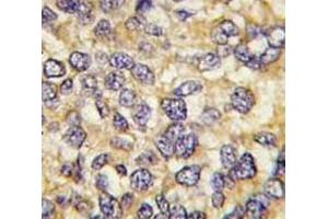 IHC analysis of FFPE human breast carcinoma tissue stained with UCHL3 antibody (UCHL3 anticorps  (AA 195-225))