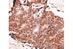 IHC analysis of FFPE human breast carcinoma tissue stained with the BMP1 antibody (BMP1 anticorps  (AA 957-986))
