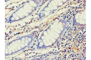 Immunohistochemistry of paraffin-embedded human colon cancer using ABIN7143993 at dilution of 1:100 (AES anticorps  (AA 1-264))