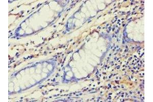 Immunohistochemistry of paraffin-embedded human colon cancer using ABIN7143993 at dilution of 1:100