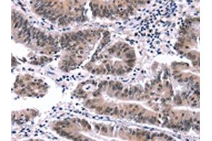 The image on the left is immunohistochemistry of paraffin-embedded Human colon cancer tissue using ABIN7191561(MYF5 Antibody) at dilution 1/15, on the right is treated with synthetic peptide. (MYF5 anticorps)