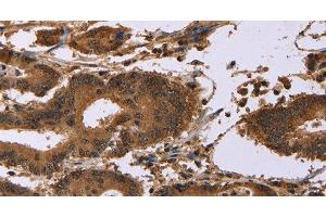 Immunohistochemistry of paraffin-embedded Human colon cancer using EDN2 Polyclonal Antibody at dilution of 1:30