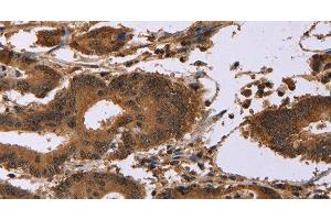 Immunohistochemistry of paraffin-embedded Human colon cancer using EDN2 Polyclonal Antibody at dilution of 1:30 (Endothelin 2 anticorps)