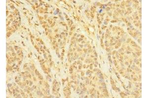 Immunohistochemistry of paraffin-embedded human ovarian cancer using ABIN7171721 at dilution of 1:100