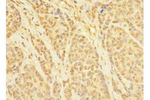 Immunohistochemistry of paraffin-embedded human ovarian cancer using ABIN7171721 at dilution of 1:100 (CCDC79 anticorps  (AA 301-550))