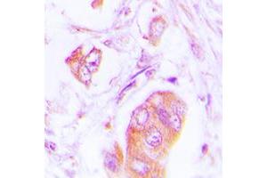 Immunohistochemical analysis of Alpha-adducin staining in human lung cancer formalin fixed paraffin embedded tissue section.