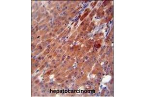 CES2 antibody (Center) (ABIN654618 and ABIN2844316) immunohistochemistry analysis in formalin fixed and paraffin embedded human hepatocarcinoma followed by peroxidase conjugation of the secondary antibody and DAB staining.
