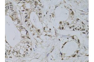 Immunohistochemistry of paraffin-embedded human gastric cancer using PML antibody (ABIN5970530) at dilution of 1/100 (40x lens). (PML anticorps)