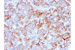 Formalin-fixed, paraffin-embedded human Gastric Carcinoma stained with CD269 / TNFRSF17 Mouse Monoclonal Antibody (BCMA/2366).