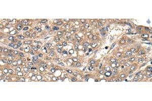 Immunohistochemistry of paraffin-embedded Human liver cancer tissue using ACER1 Polyclonal Antibody at dilution of 1:50(x200) (ACER1 anticorps)