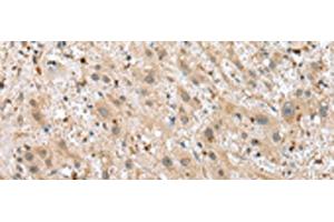 Immunohistochemistry of paraffin-embedded Human liver cancer tissue using TPPP Polyclonal Antibody at dilution of 1:25(x200) (Tppp anticorps)