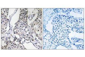 Immunohistochemistry analysis of paraffin-embedded human breast carcinoma tissue using PHLDA3 antibody. (PHLDA3 anticorps  (Internal Region))