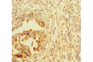 Immunohistochemistry of paraffin-embedded human pancreatic cancer using ABIN7172767 at dilution of 1:100 (ATRX anticorps  (AA 2161-2443))