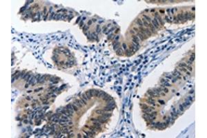 The image on the left is immunohistochemistry of paraffin-embedded Human colon cancer tissue using ABIN7190002(BPIFB1 Antibody) at dilution 1/40, on the right is treated with synthetic peptide. (BPIFB1 anticorps)