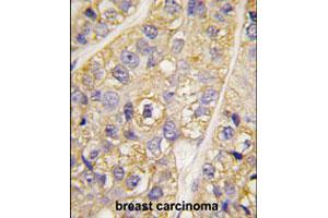Formalin-fixed and paraffin-embedded human breast carcinoma tissue reacted with PI4K2B polyclonal antibody  , which was peroxidase-conjugated to the secondary antibody, followed by DAB staining. (PI4K2B anticorps  (N-Term))
