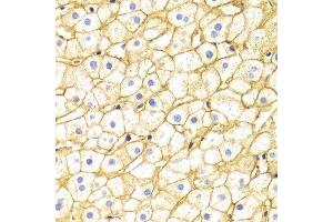 Immunohistochemistry of paraffin-embedded Human liver injury using BSG antibody at dilution of 1:100 (x400 lens).