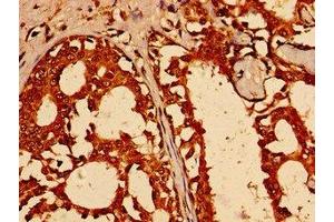 Immunohistochemistry of paraffin-embedded human breast cancer using ABIN7172475 at dilution of 1:100