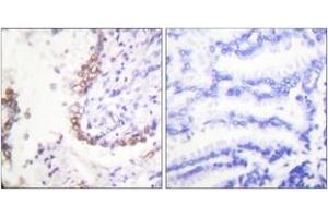 Immunohistochemistry analysis of paraffin-embedded human lung carcinoma tissue, using OCT3 Antibody. (SLC22A8 anticorps  (AA 191-240))