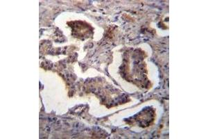 Immunohistochemistry analysis of GUF1 Antibody (N-term) in formalin fixed and paraffin embedded human prostate carcinoma followed by peroxidase conjugation of the secondary antibody and DAB staining.
