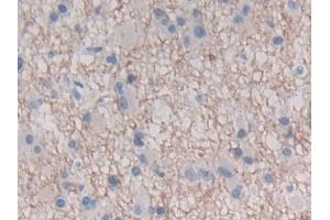DAB staining on IHC-P; Samples: Human Glioma Tissue (IFNE anticorps  (AA 30-208))