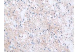 Detection of FBN1 in Human Glioma Tissue using Polyclonal Antibody to Fibrillin 1 (FBN1)