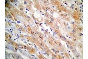 Human hepatocellular carcinoma tissue was stained by Rabbit Anti-FGF-21 (26-47) (H) Antibody (FGF21 anticorps  (AA 26-47))