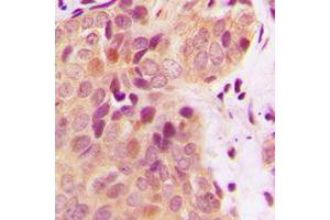 Immunohistochemical analysis of BRCA2 staining in human breast cancer formalin fixed paraffin embedded tissue section.
