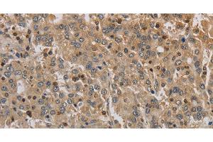 Immunohistochemistry of paraffin-embedded Human liver cancer using ADO Polyclonal Antibody at dilution of 1:30 (ADO anticorps)