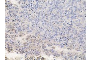 ABIN6256798 and ABIN6267346 at 1/100 staining human melanoma by IHC-P.