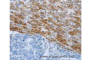 Immunohistochemistry of Human liver cancer using PSMD11 Polyclonal Antibody at dilution of 1:50 (PSMD11 anticorps)