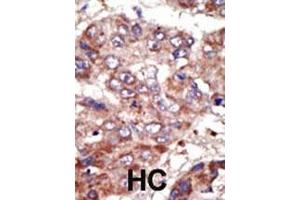 Formalin-fixed and paraffin-embedded human cancer tissue reacted with the primary antibody, which was peroxidase-conjugated to the secondary antibody, followed by AEC staining. (ACSL6 anticorps  (AA 240-270))