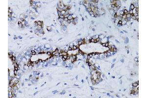 Immunohistochemistry of paraffin-embedded human breast cancer using BRCA1 antibody. (BRCA1 anticorps)