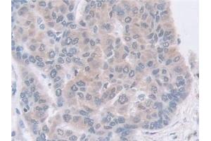 Detection of GDA in Human Liver cancer Tissue using Polyclonal Antibody to Guanine Deaminase (GDA)