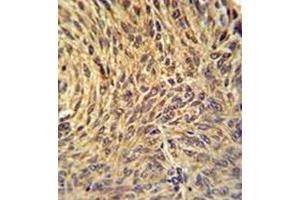 Immunohistochemistry analysis in formalin fixed and paraffin embedded human lung carcinoma reacted with NUP210 / GP210 Antibody (N-term) followed by peroxidase conjugation of the secondary antibody and DAB staining.