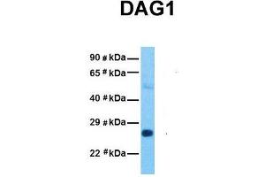 Host:  Rabbit  Target Name:  DAG1  Sample Tissue:  Human Stomach Tumor  Antibody Dilution:  1. (Dystroglycan anticorps  (Middle Region))