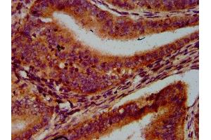 IHC image of ABIN7167068 diluted at 1:600 and staining in paraffin-embedded human endometrial cancer performed on a Leica BondTM system.