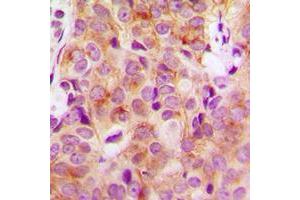 Immunohistochemical analysis of HGS staining in human breast cancer formalin fixed paraffin embedded tissue section.