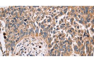 Immunohistochemistry of paraffin-embedded Human lung cancer using FUCA1 Polyclonal Antibody at dilution of 1:30