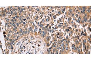 Immunohistochemistry of paraffin-embedded Human lung cancer using FUCA1 Polyclonal Antibody at dilution of 1:30 (FUCA1 anticorps)