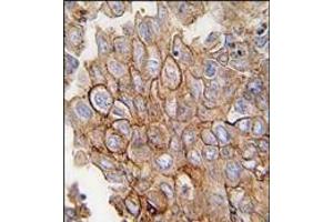 Formalin-fixed and paraffin-embedded human lung carcinoma tissue reacted with ANXA2 antibody (C-term), which was peroxidase-conjugated to the secondary antibody, followed by DAB staining. (Annexin A2 anticorps  (C-Term))