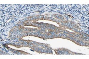 ABIN6278876 at 1/100 staining Human cervical cancer tissue by IHC-P. (IFIT2 anticorps  (Internal Region))