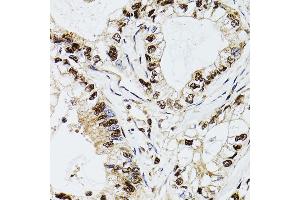 Immunohistochemistry of paraffin-embedded human gastric cancer using DCK antibody (ABIN3022557, ABIN3022558, ABIN3022559 and ABIN6218902) at dilution of 1:100 (40x lens).