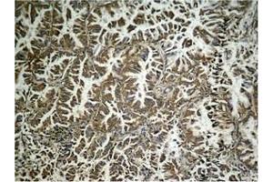 Immunohistochemical analysis of paraffin-embedded human lung carcinoma tissue, using eIF2α (Phospho-Ser49) Antibody.